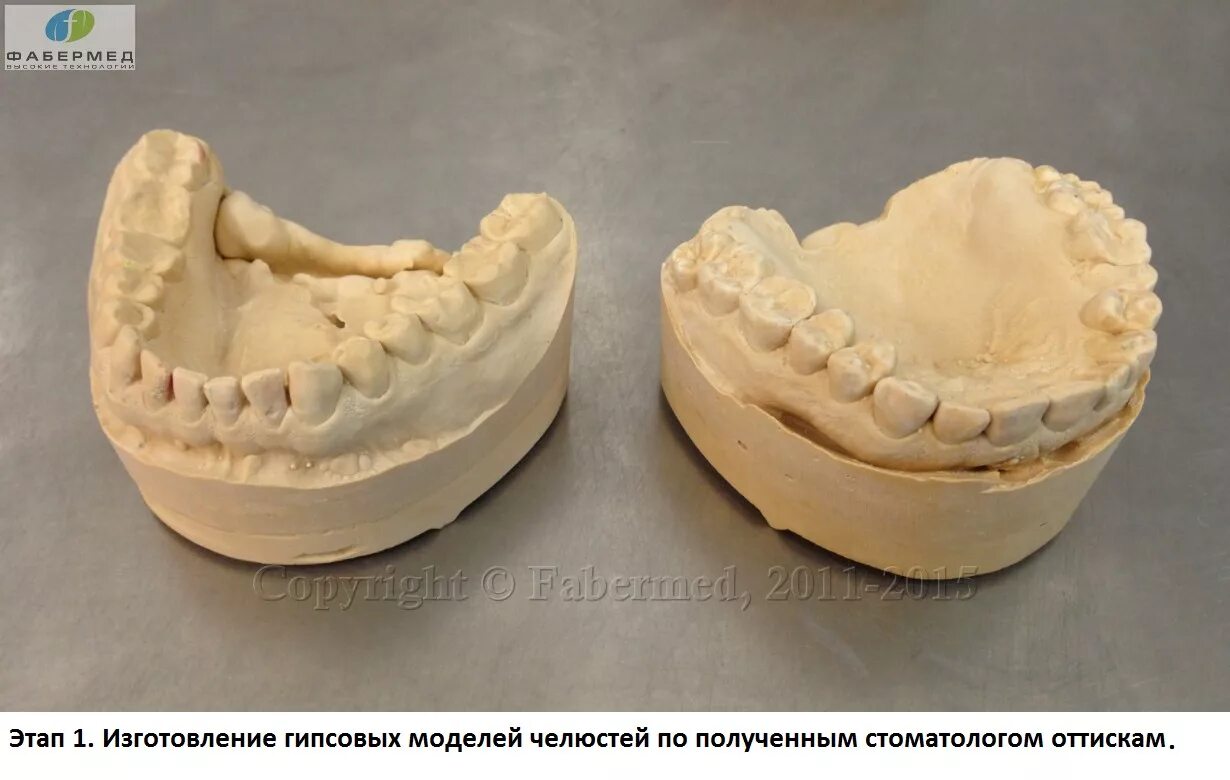 Изготовление гипсовой модели. Гипсовые модели челюстей. Гипсовая Медель челючти. Отливка гипсовых моделей челюстей. Гипсовые модели в стоматологии.