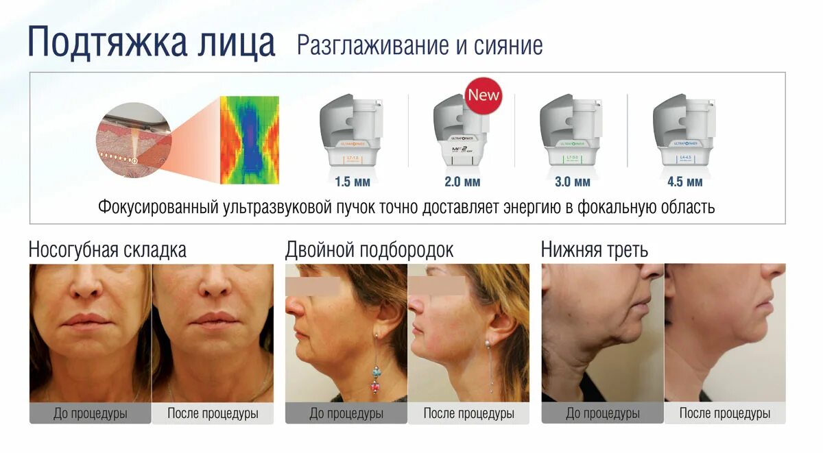 альтера-терапия ultherapy. ультразвуковая подтяжка лица отзывы. альтера ультразвуковой лифтинг. альтера безоперационный лифтинг. безоперационная ультразвуковая подтяжка лица.