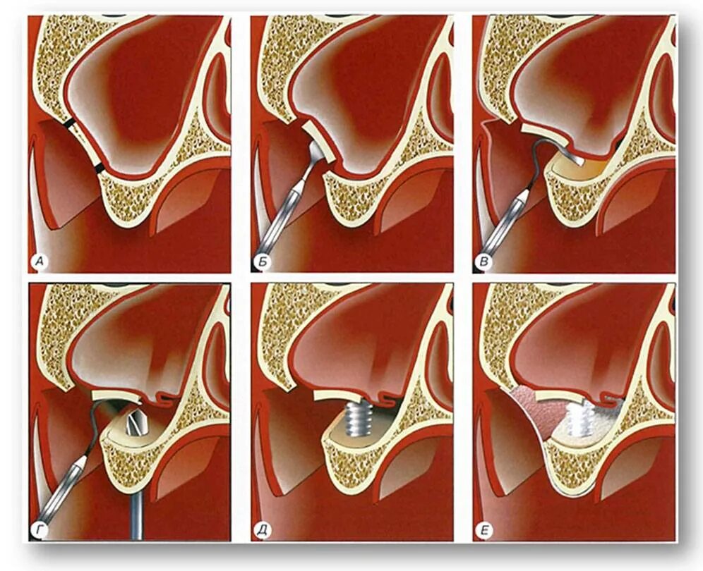 Синус-лифтинг (костная пластика, остеопластика) открытый. Синус-лифтинг (костная пластика, остеопластика) закрытый. Синус-лифтинг (в зависимости от метода). Остеотомный синус лифтинг. Синус десны
