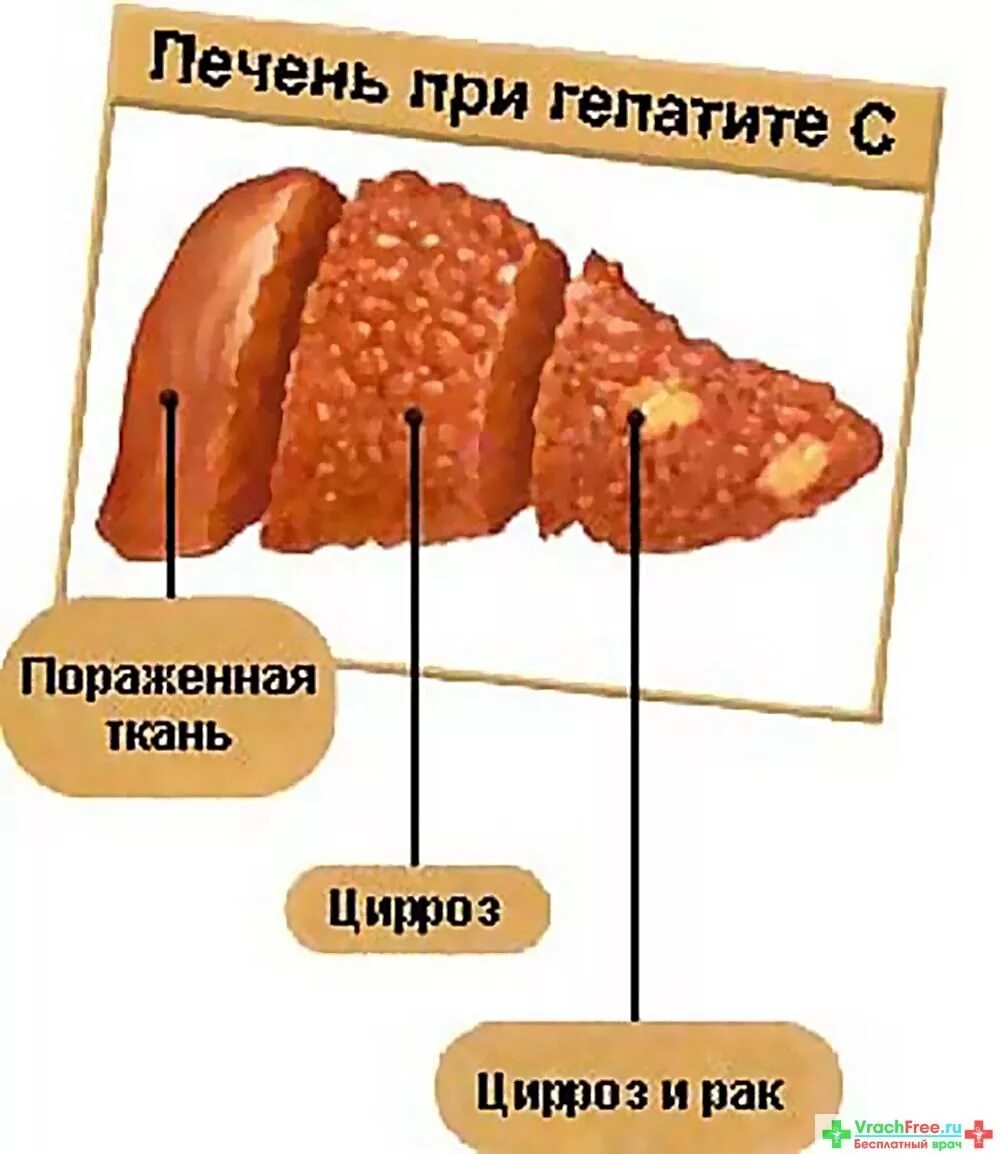 При гепатите с делают операции. Печень пораженная гепатитом.