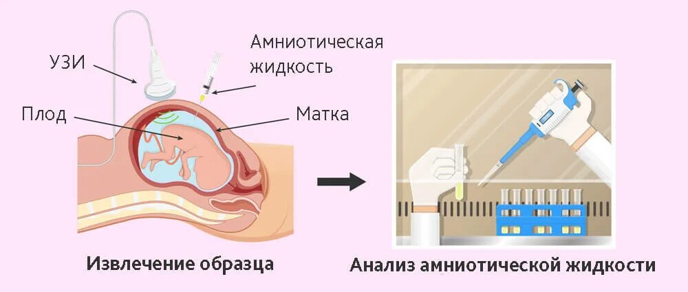 Инвазивное исследование при беременности. Инвазивные виды. Инвазивный виды пренатальной