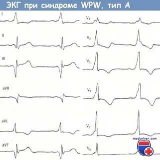 Синдром wpw тип а
