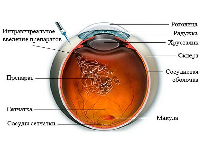 Интравитреальная инъекция. Интравитреальное Введение препарата Луцентис. Интравитреальные инъекции ингибиторов ангиогенеза. Интравитреальное Введение в глаз. Интровертальное Введение ингебитора.