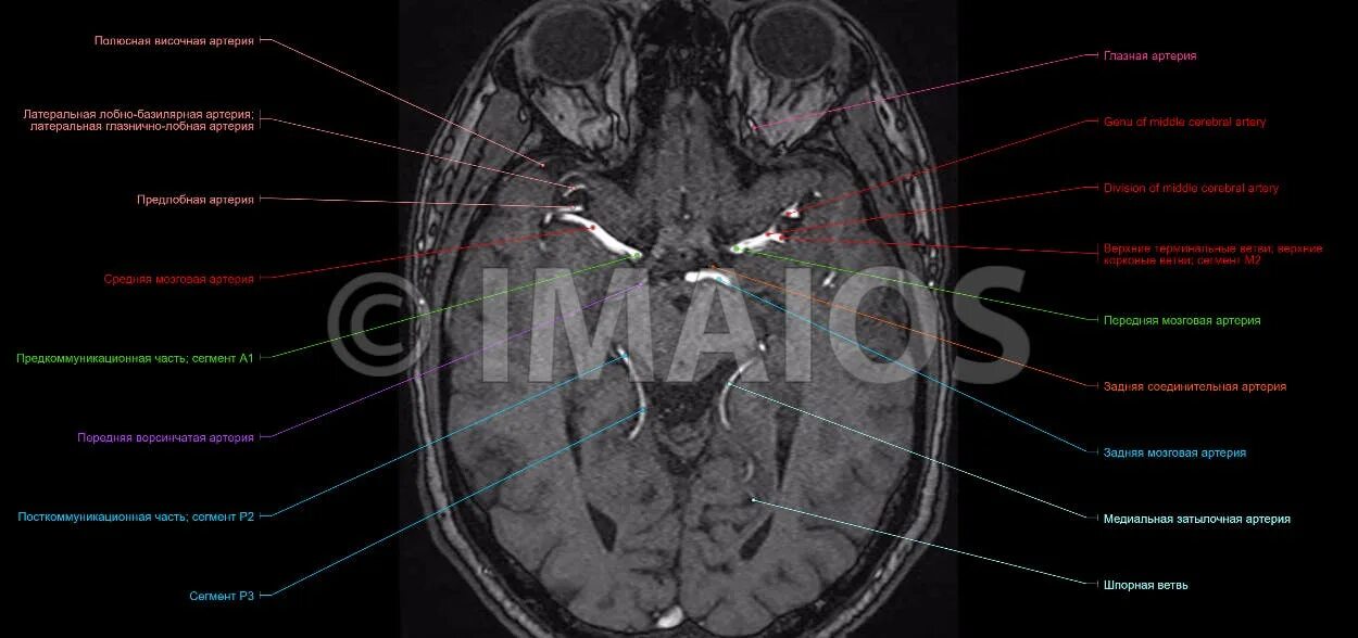 Виллизиев круг вариант развития на мрт. Задние соединительные артерии головного мозга на кт. Виллизиев круг мрт. Артерии головного мозга на мрт. Анатомия Виллизиева круга мрт.