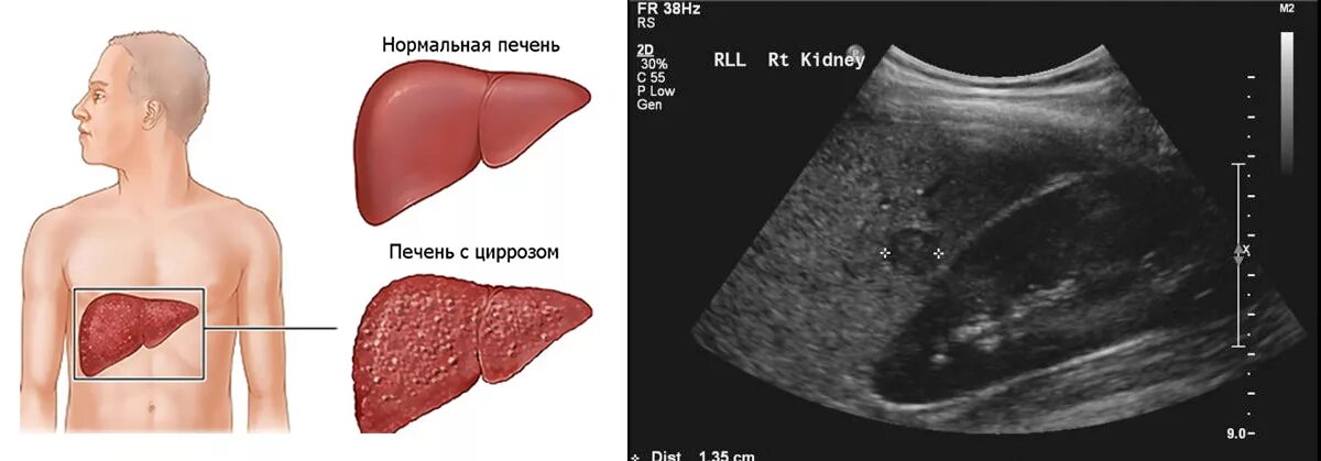 Увеличенная печень на узи. Печень на УЗИ В норме и при циррозе. Как выглядит печень при циррозе на УЗИ. Цирроз печени на УЗИ фото. Цирроз печени эхограмма.