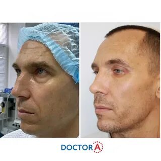Блефаропластика хирурги отзывы