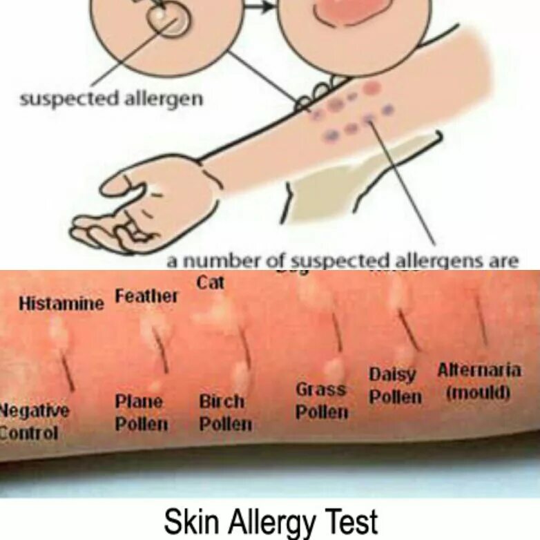 Как отличить аллергическую. Скарификационные пробы на аллергены. Кожные пробы на аллергены реакция. Кожное тестирование аллергопробы. Пробы на аллергены Результаты кожные.