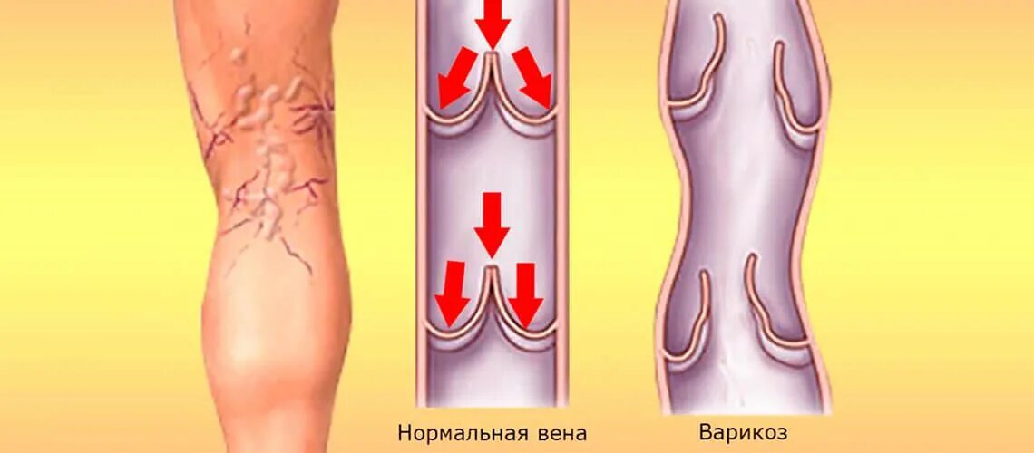 Что значит расширение вен. Варикозно расширенная Вена. Варикозное расширение ве. Нормальные и варикозные вены.