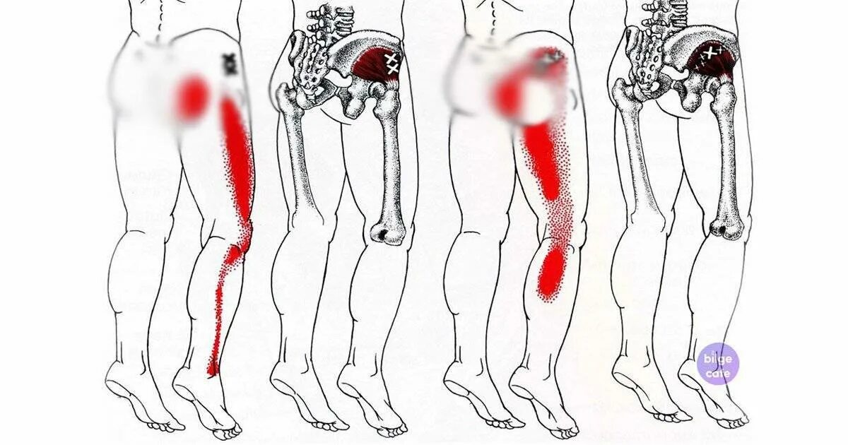 Почему тянет ногу от бедра до колена. Воспаление седалищного нерва. Дискомфорт в правом бедре и ягодице.