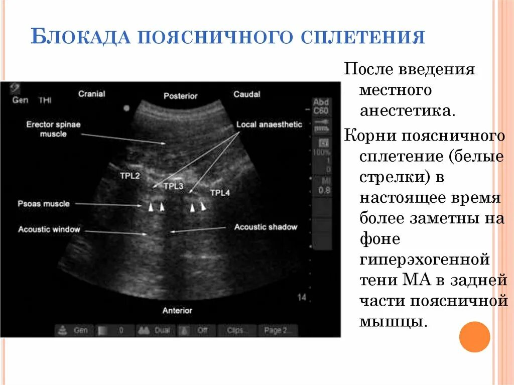 Фасеточная блокада. Блокада пояснично крестцового сплетения. УЗИ пояснично-крестцового сплетения. Поясничное сплетение УЗИ. Блокада под контролем УЗИ.