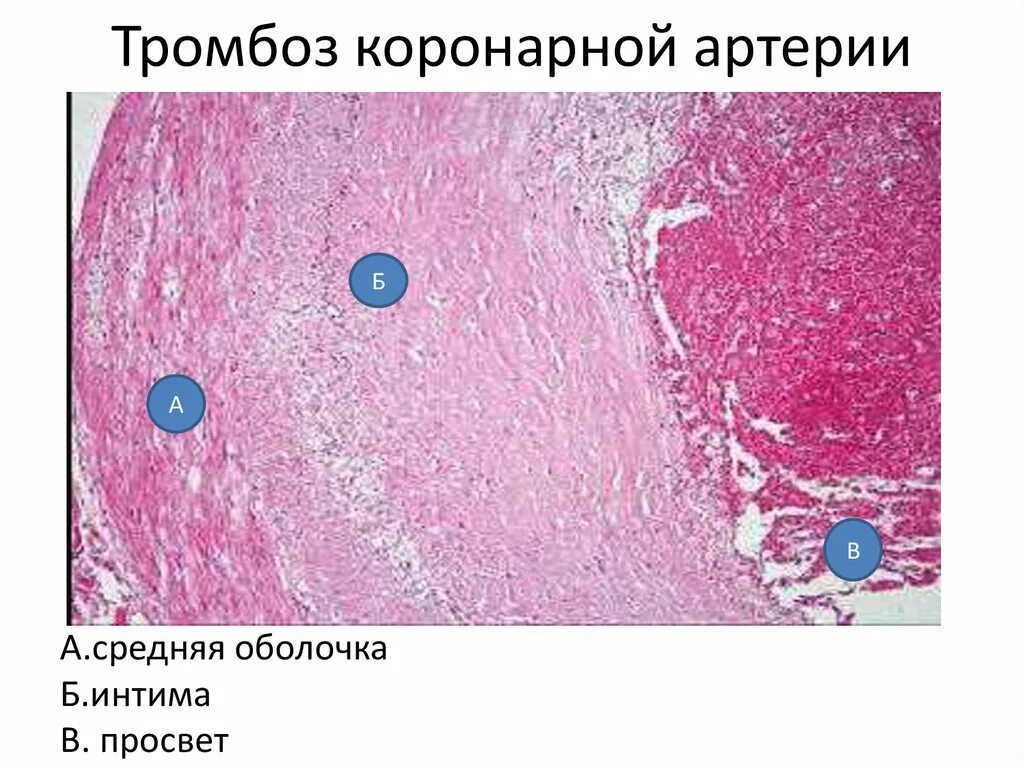 Тромбоз коронарной артерии микропрепарат. Атеросклероз сосудов гистология. Атеросклероз артерий гистология. Артериальный тромб патанатомия. Пристеночный тромбоз