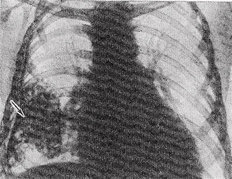 Очаговые тени в легких на рентгене. Плотные тени в легком. Очаговая тень рентген. Фиброзно очаговый туберкулез рентген. Очаговые тени в легких на рентгене.