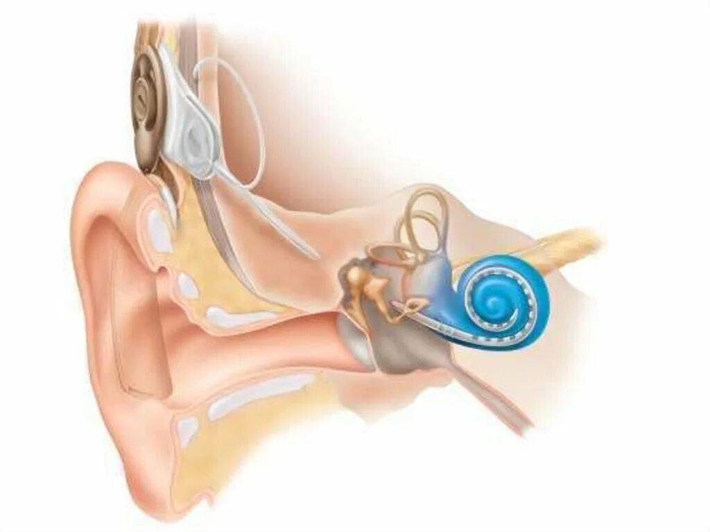 Поражение слухового нерва. Кохлеарный неврит слухового нерва. Слуховой аппарат нейросенсорная тугоухость. Кохлеарный неврит инфекционный.