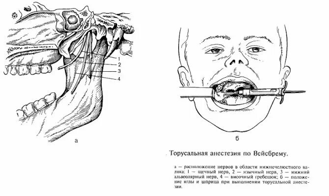 Мандибулярная анестезия методика. Торусальная анестезия нижней челюсти. Проводниковая анестезия на нижней челюсти методика. Проводниковая анестезия в стоматологии торусальная. Проведение проводниковой анестезии