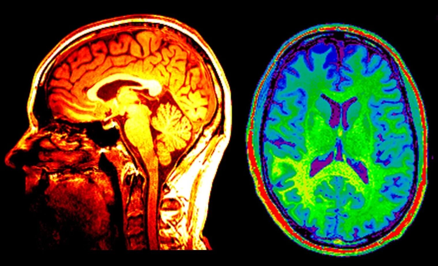 Томография головного мозга. Магнитно-резонансная томография головного мозга. Мрт мозга. Снимки мрт головного мозга.