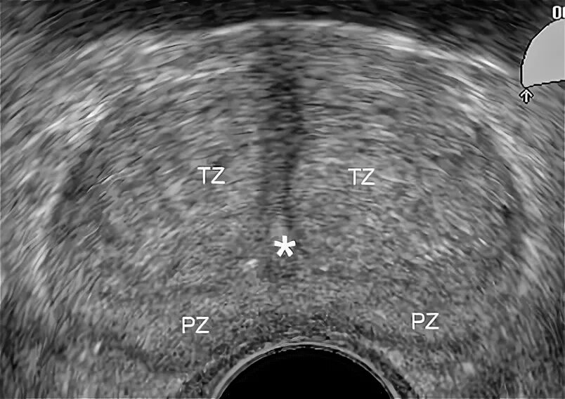 Точка простаты. Предстательная железа анатомия зоны УЗИ. Зональная анатомия предстательной железы УЗИ. Периуретральная зона предстательной железы. Трузи предстательной железы анатомия.