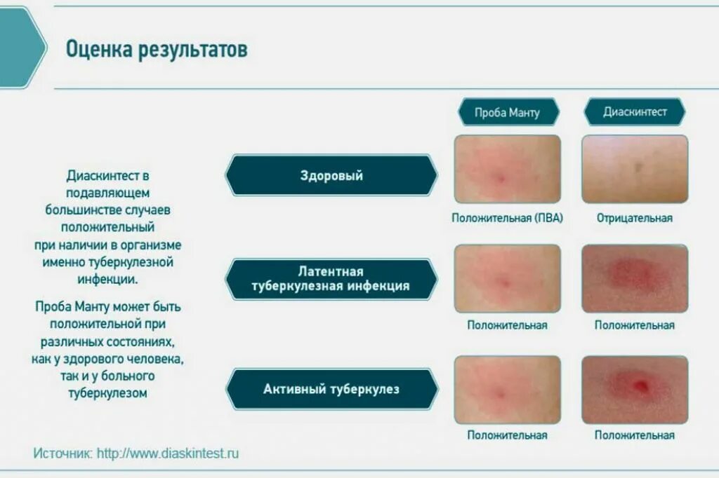 Сколько см манту. Реакция на туберкулез диаскинтест. положительная манту папула. диаскинтест отсутствует кожная реакция. диаскинтест папула 5мм.