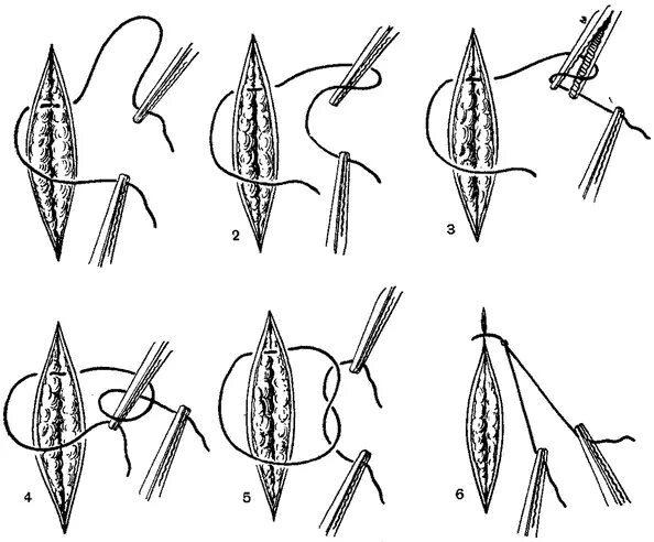 Узловатый шов хирургия. Геморроидэктомия по миллигану-моргану. Узловатый шов хирургия. Операция по миллигану моргану. Операция миллигана моргана схема.