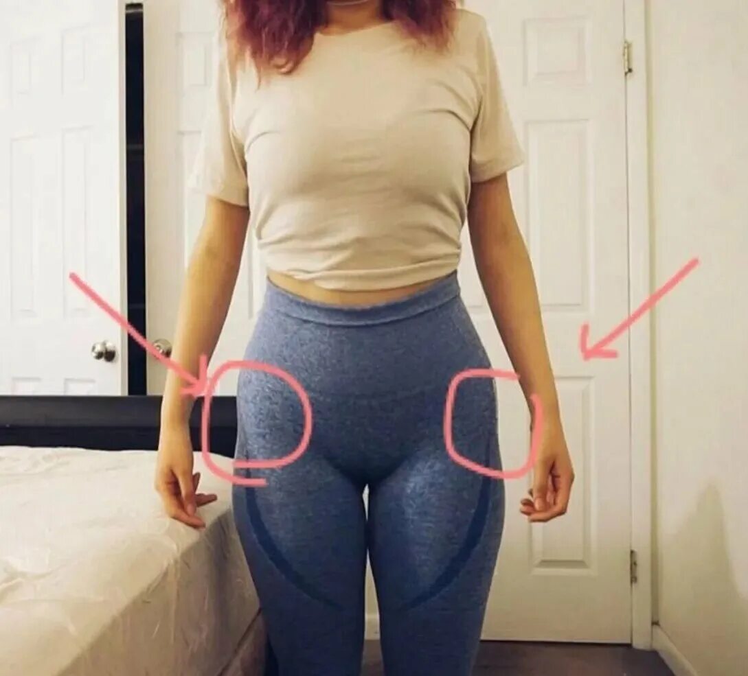 ушки на бедрах. неровные бедра. липодистрофия целлюлит. неровные бедра. неровные бедра.