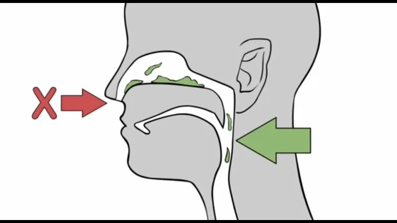 синдром назального затекания. что делать если сопли стекают. -++воспаление слизистой оболочки носа - ринит. сопли застряли в носоглотке. средство для разжижения соплей у взрослого.