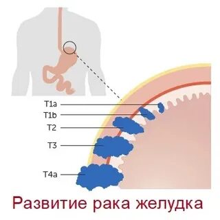4 стадия рака желудка сколько