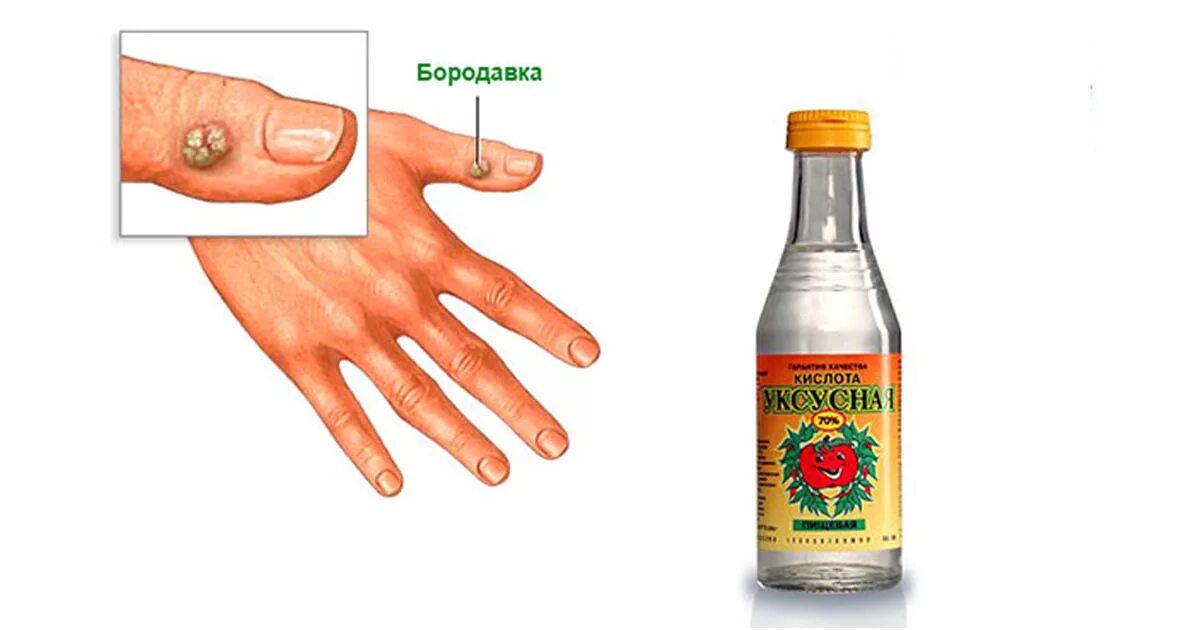 Можно ли уксусом удалить
