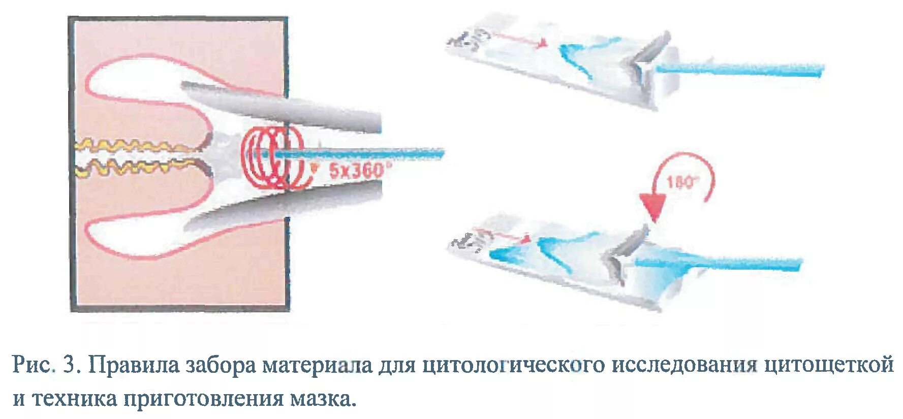 Что такое жидкостная цитология шейки матки. Алгоритм взятия мазка на цитологию шейки матки. Техника взятия мазков на цитологическое исследование. Техника забора мазка на онкоцитологию с шейки матки. Техника забора мазка на цитологическое исследование.