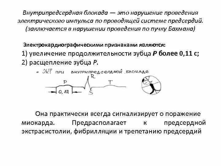 Что значит внутрипредсердная внутрипредсердная блокада. ЭКГ при блокаде пучка Бахмана. Блокада пучка Бахмана на ЭКГ. Внутрипредсердная блокада на ЭКГ. Внутрипредсердная блокада Бахмана.