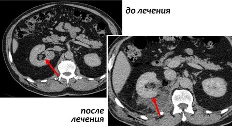 Метастазы в почки сколько живут