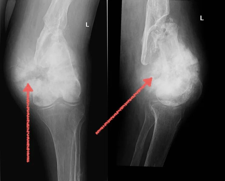Степени саркомы. Остеосаркома бедренной кости рентген. Саркома Юинга бедренной кости рентген. Остеогенная саркома рентген. Остеосаркома коленного сустава рентген.