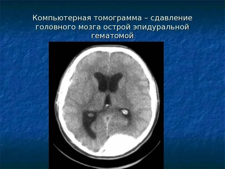 Гематома черепно мозговой травме. Эпидуральная гематома на кт. Черепно мозговая травма кт и мрт. Внутричерепные гематомы кт. Сдавление головного мозга кт.