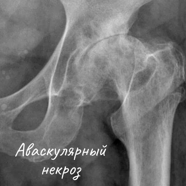 Боли при некрозе тазобедренных суставов