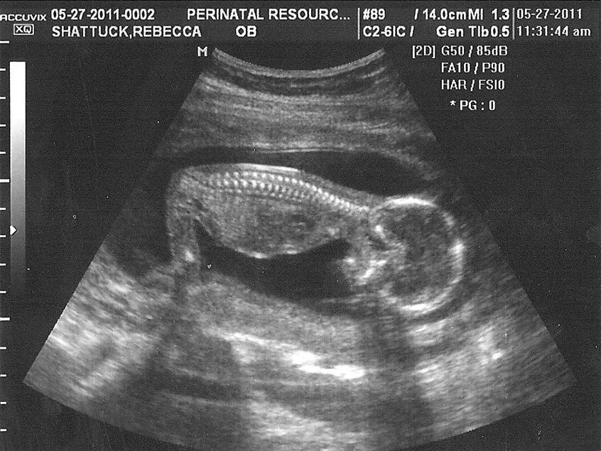 узи 20 недель беременности мальчик или девочка. 17 неделя беременности узнать пол. узи на 16-17 неделе беременности пол ребенка. как выглядит девочка на узи. пол ребенка на узи.