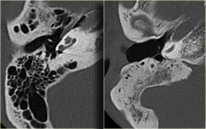 Холестеатома ячеек сосцевидного отростка. Сосцевидный отросток височной кости кт. Холестеатома среднего уха на кт. Склероз ячеек сосцевидного отростка височных костей. Утолщение слизистой сосцевидного отростка