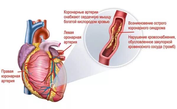 Острая сердечная коронарная недостаточность. Нарушение кровотока в коронарной артерии. Коронарные артерии снабжают сердечную мышцу. Острый коронарный синдром. Коронарные сосуды сердца.