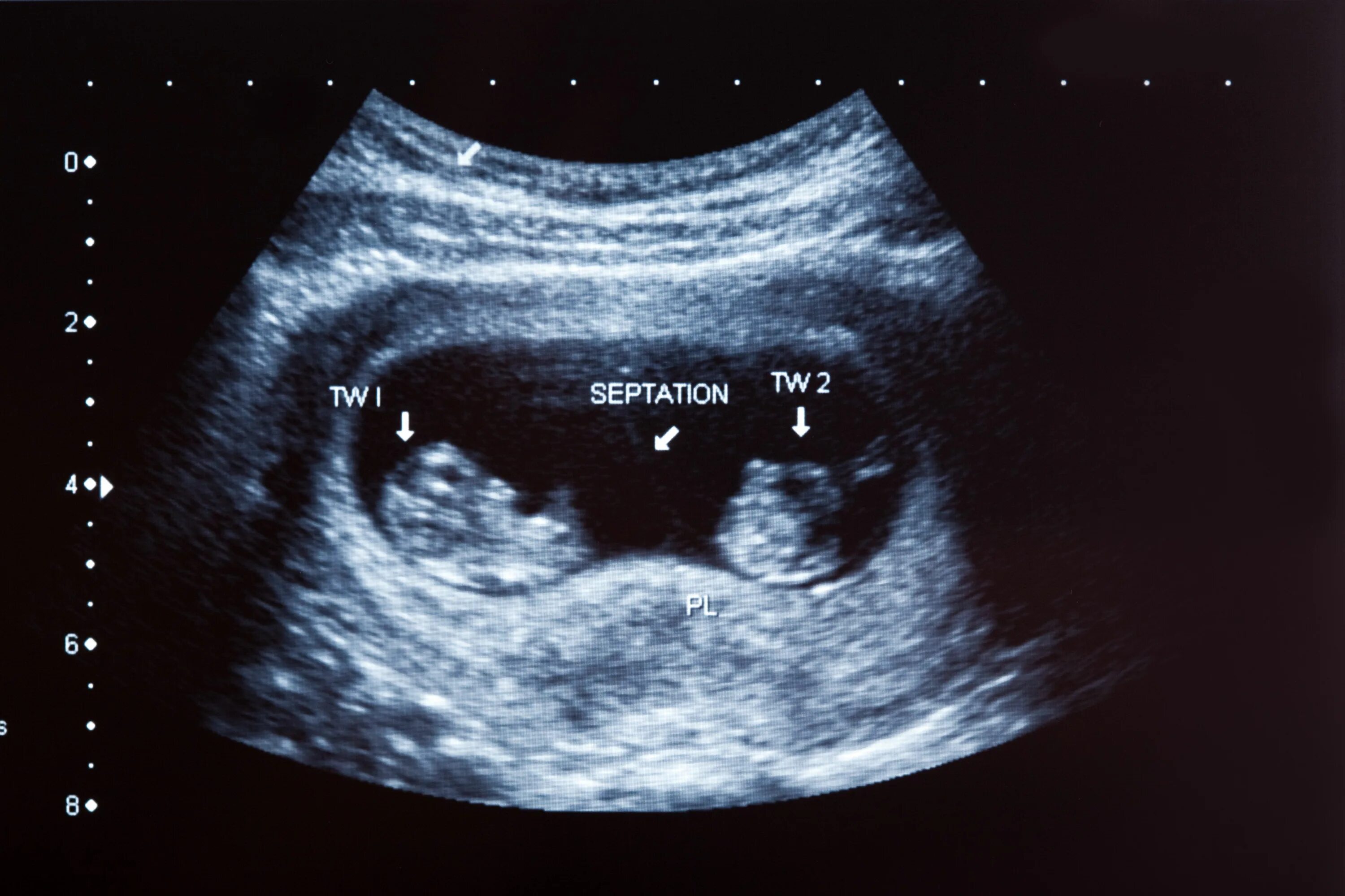 УЗИ 12 недель беременности двойня. УЗИ 10 недель беременности двойня. УЗИ 8 недель беременности двойня. УЗИ 20 недель беременности многоплодная беременность.