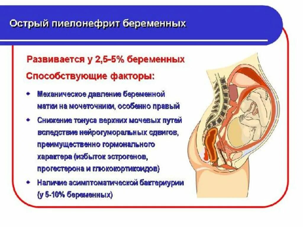 Пиелонефрит 2 триместр. Гестационный острый пиелонефрит симптомы. Пиелонефрит у беременных. Пиелонефрит при беременности. Острый пиелонефрит у беременных.