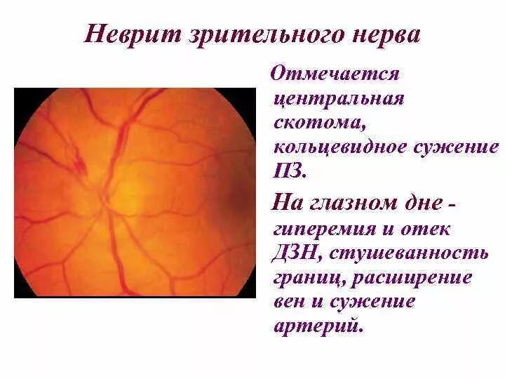 Тип зрительного нерва. Патогенез ретробульбарного неврита зрительного нерва. Ретробульбарный неврит глазное дно. Ретробульбарный неврит зрительного нерва офтальмология. Застоя и неврита зрительного нерва.