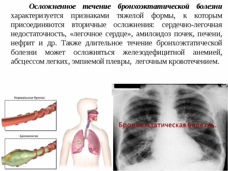 Осложнения бронхоэктатическая. Бронхоэктатическая болезнь этиология. внелегочные проявления бронхоэктатической болезни. осложнения бронхоэктатической болезни. бронхоэктатическая болезнь осложнения.