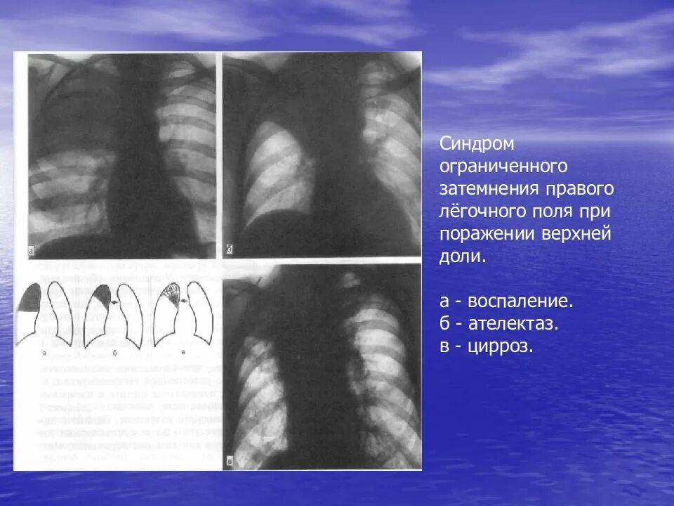 Верхние доли легких тени. Синдром обширного затемнения легочного поля. Синдром ограниченного затемнения легочной ткани. Ателектаз правой верхней доли. Синдром ограниченного затемнения легочного поля рентген.