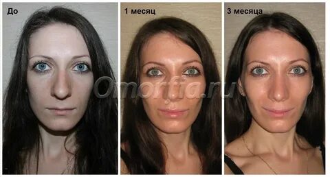 Ринопластика отек сколько