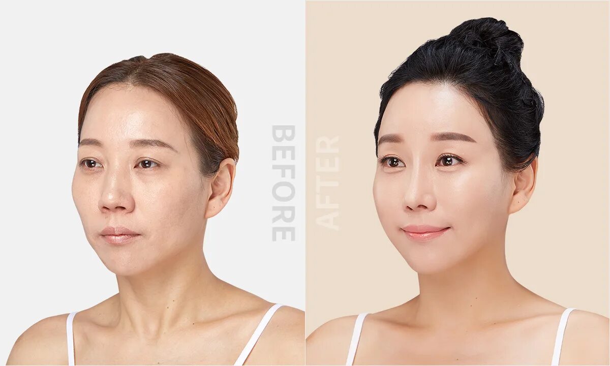 Липолитик в нос до и после. Лица алматы. Тореали толепов. Лица алматы. Лица алматы.