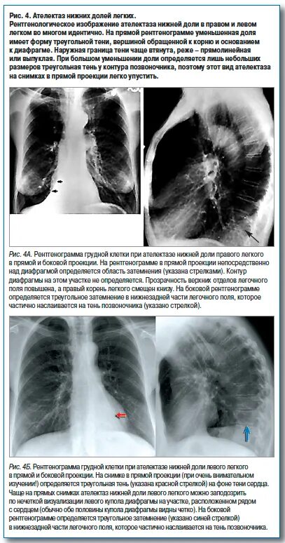 Пневмония в правой нижней доле. Ателектаз доли рентген. Ателектаз доли легкого рентген. Ателектаз легких средней доли. Ателектаз легких на рентгене описание.