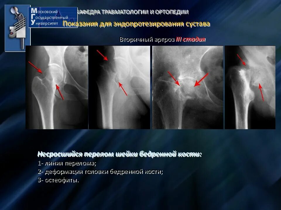 Операция по квоте замена тазобедренного сустава. Плазмоцитома тазобедренного сустава. эндопротезирование тазобедренного сустава. эндопротезирование плечевого сустава. после эндопротезирования тазобедренного сустава.