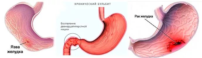 Боли в желудке после острого. Если сильно болит желудок.