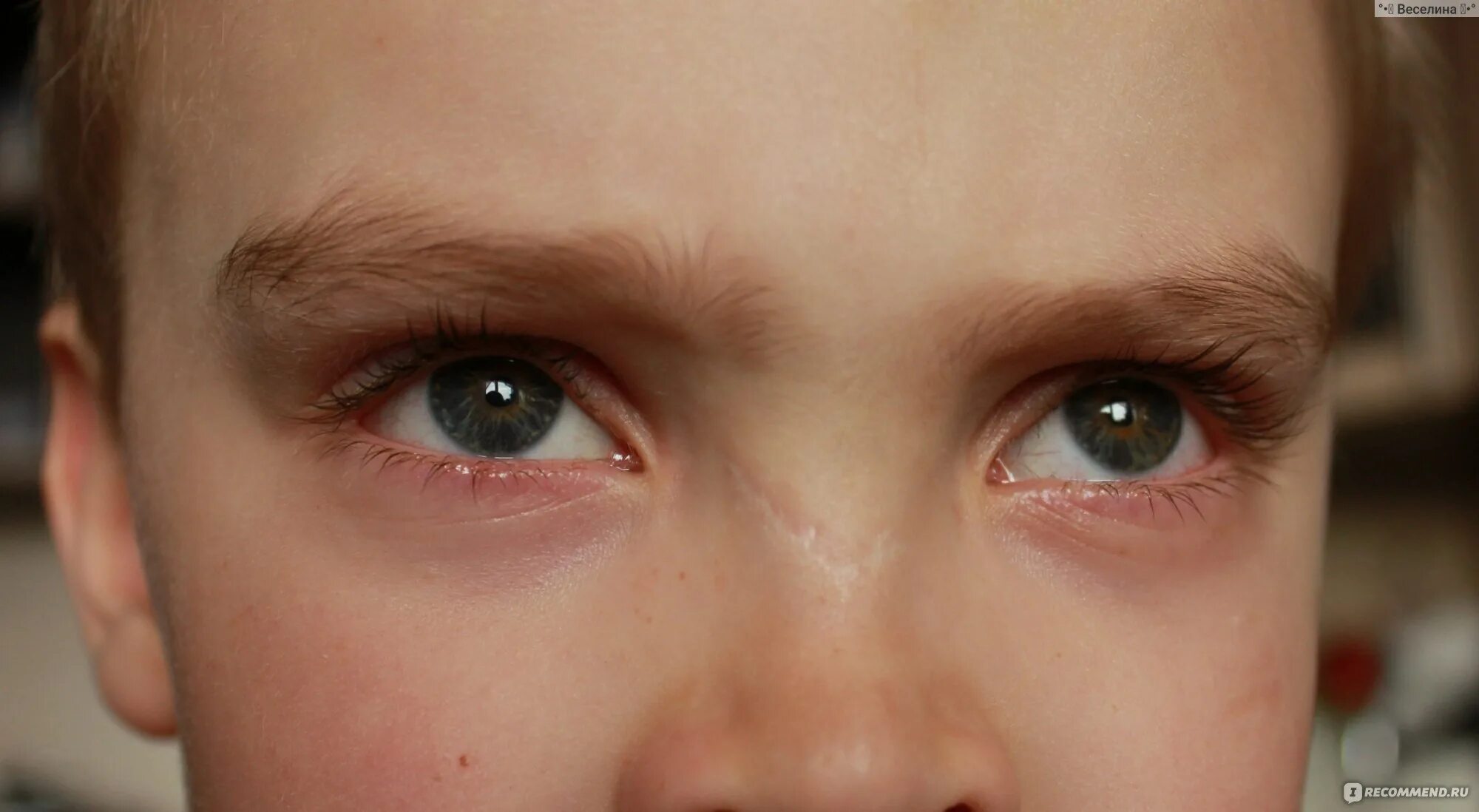 Конъюнктивит ребенка 7 лет. Конъюнктивит у подростка. Аллергический конъюнктивит под глазами. Конъюнктивит у детей прыщ. Аллергический конъюнктивит глаза у детей.