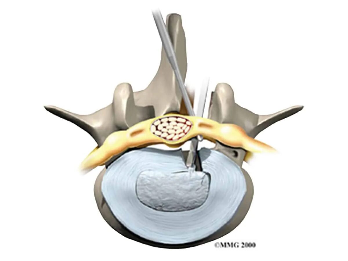 Дискэктомия поясничного отдела позвоночника. Микродискэктомия грыжи позвоночника. Стеноз позвоночного канала операция.