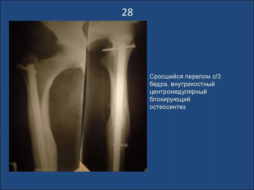Сколько заживает бедро. Сросшийся перелом бедра рентгенограмма. Сросшийся перелом бедренной кости рентген. Сросшийся перелом шейки левой бедренной кости. Перелом н/3 бедренной кости.