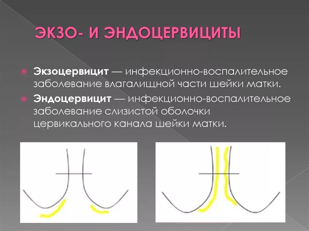 Эндоцервикс признаки. Заболевание эндоцервицит. Воспалительный процесс слизистой оболочки экзоцервицит.