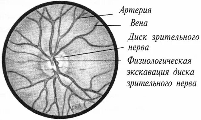 Норма зрительного нерва. Строение диска зрительного нерва. Экскавация диска зрительного нерва. Выраженный застойный диск зрительного нерва. Кровоснабжение ДЗН.